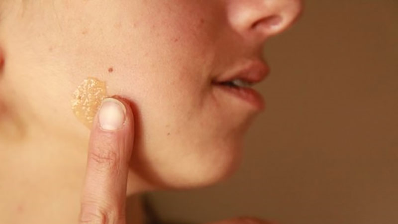 درمان لکه های قارچی، کهیر و خارش پوست با عسل